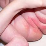 Детски дерматит: причини за заболяването, симптоми и процес на лечение